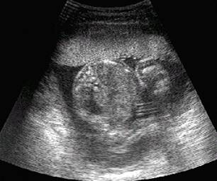 Typical ultrasound image