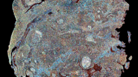 A broadband SRS image of human head and neck tumour tissue with scale indicated 